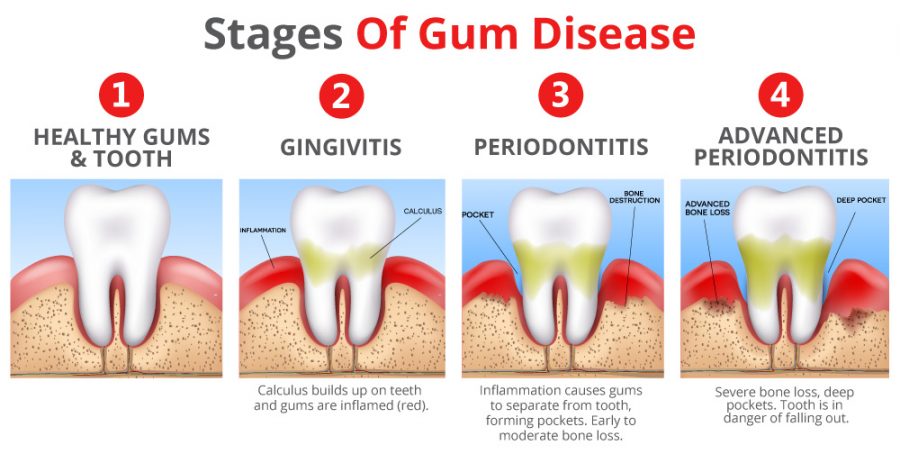 https://www.parkplacedental.co.uk/wp-content/uploads/2019/12/stages-of-gum-disease.jpg