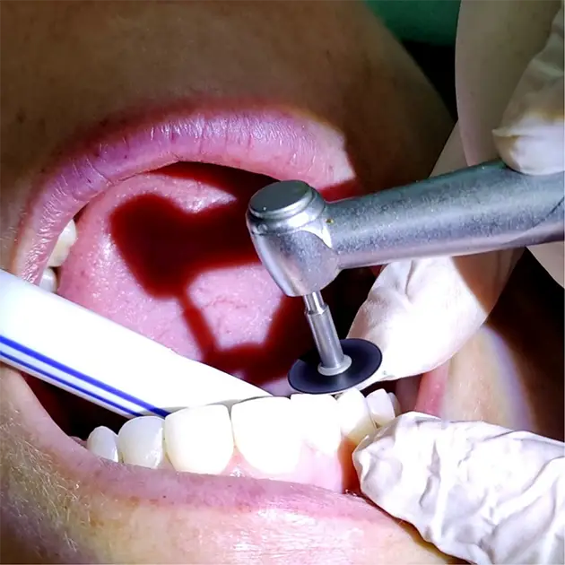 Polishing of composite bonding by a dentist