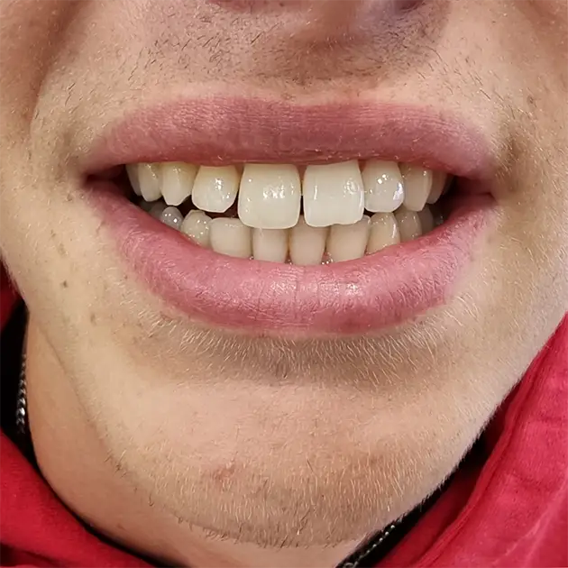 Patient smiling after having composite bonding to a broken tooth