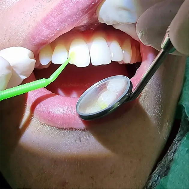Patient smiling after composite bonding for her teeth
