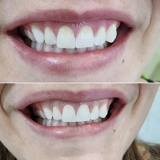 Before and after pictures showing a patient smiling after her composite bonding treatment